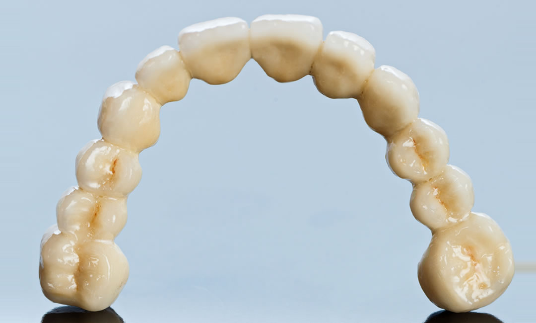Zubni most kao rješenje nedostatka zuba