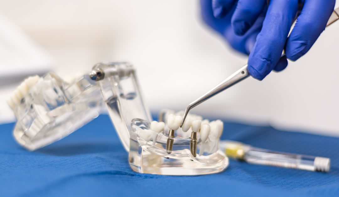 Kako vam zubni implantati mogu promijeniti život