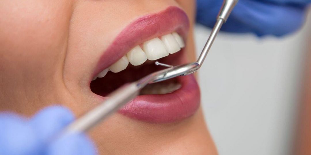 Zubni plak i kamenac – kako ih razlikovati (i kako ih se riješiti)