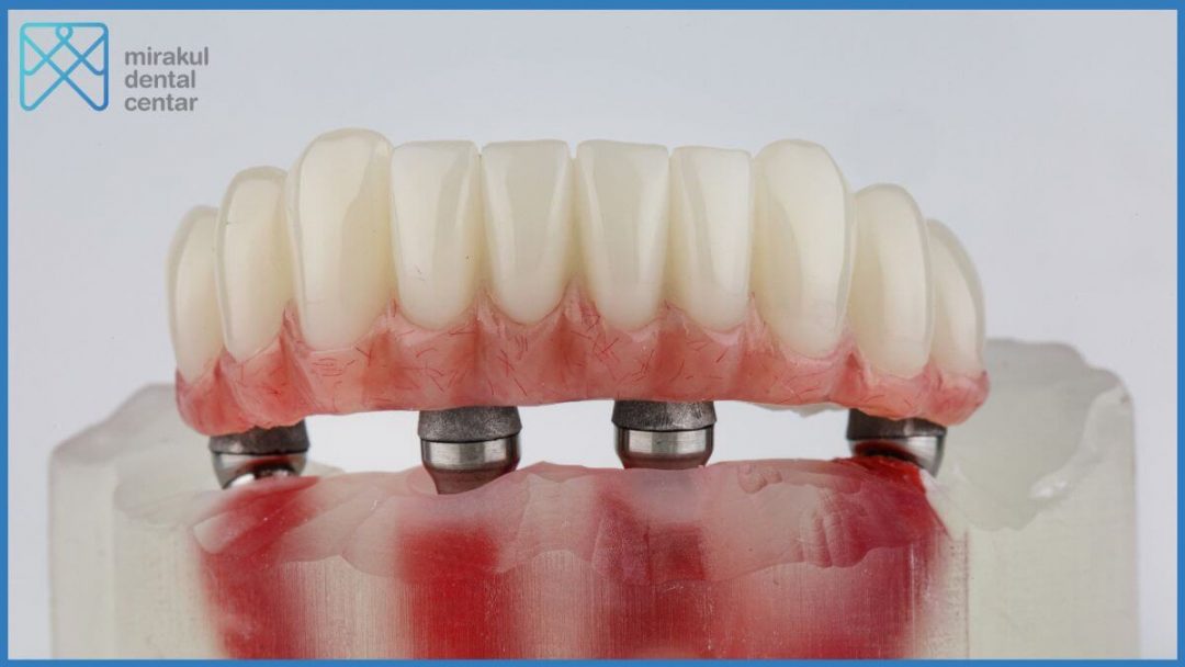 Proteza na implantatima – sve što vas zanima