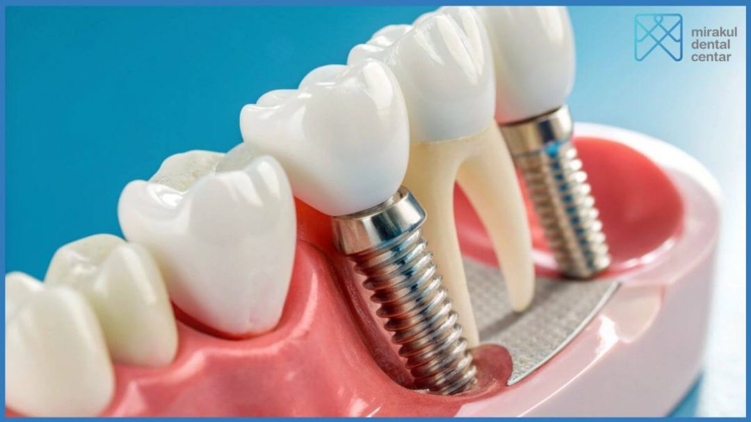 Nedostatak jednog zuba i nadomjestak zuba – čekati ili odmah reagirati